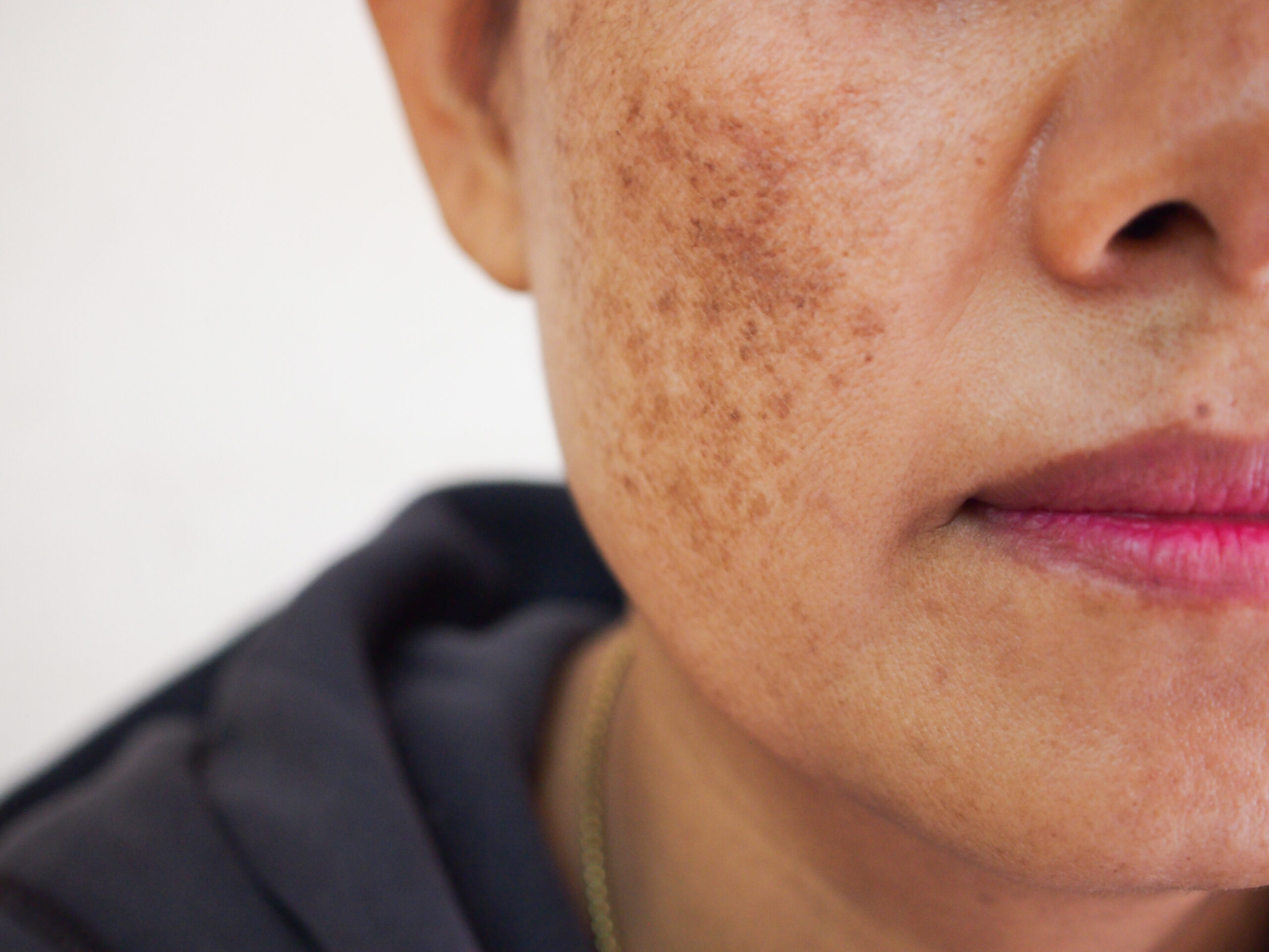 Treatment of Pigmented Spots