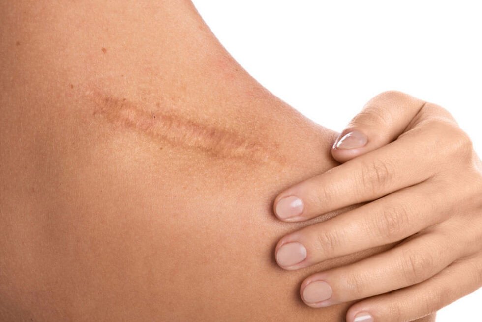 Scar Treatment North Pacific Dermatology Dermatology