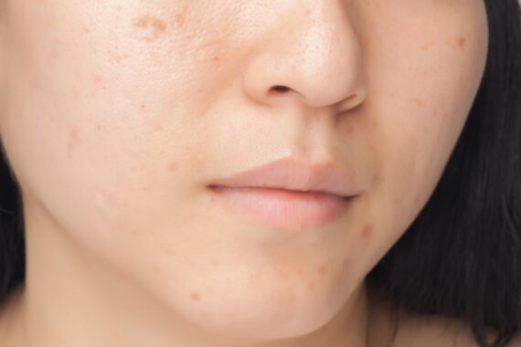 Acne as a Teen? How to Fix Adult Skin