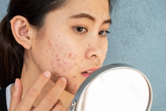 How Will a Dermatologist Help with My Acne Problem?