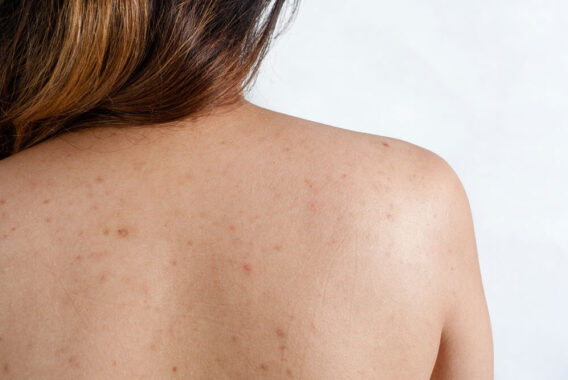 Clear Up Body Acne With These 4 Tips