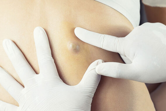 Cyst Removal: Is it Always Necessary?