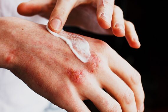 Have Eczema? Prevent Cracking and Skin Infection with These Tips