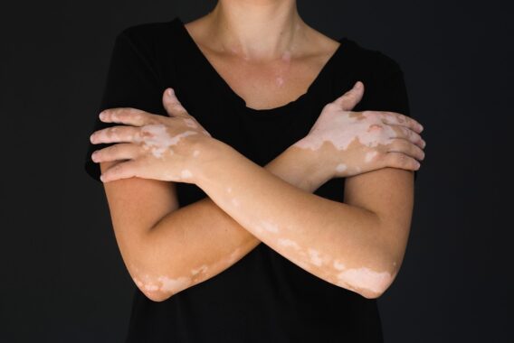 Diagnosed with Vitiligo? Consider Light Therapy Treatment