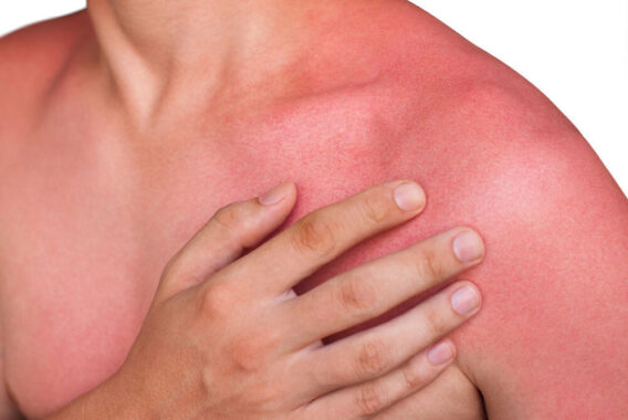 How to Get Relief After a Sunburn