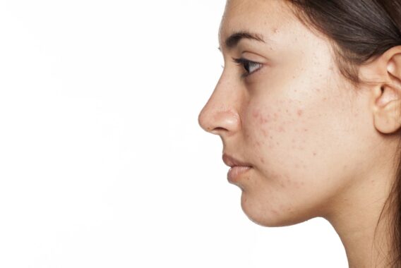 How to Treat Acne Prone Dry Skin This Winter