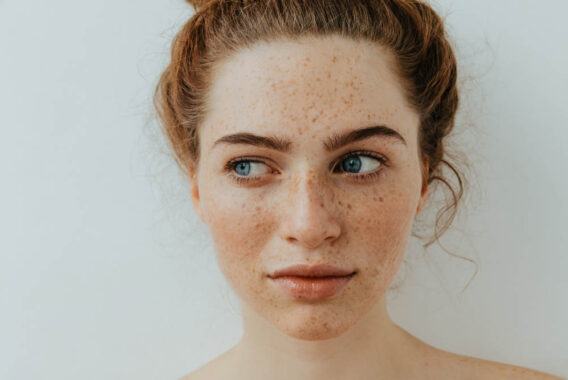 How to Reduce Freckles
