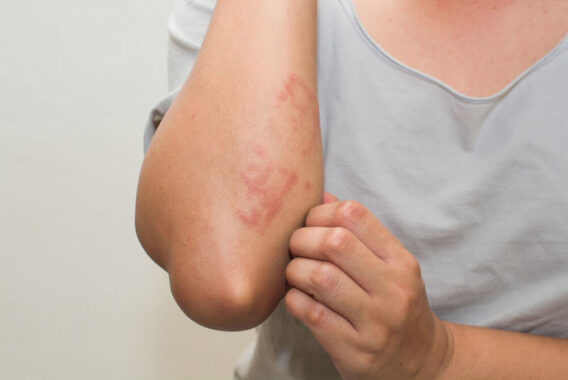 5 Ways to Lessen Itch From Poison Oak and Poison Ivy