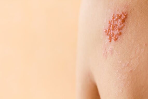 Am I at Risk for Shingles? Know the Signs of Herpes Zoster