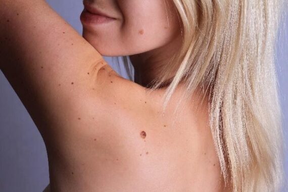 Celebrate Skin Cancer Awareness Month by Getting a Mole Evaluation