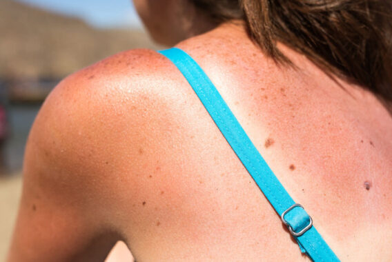 Skin Cancer Awareness Month: Are There Risk Factors for Skin Cancer?