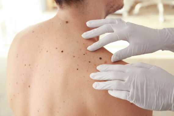 Can You Be Too Young for Melanoma?