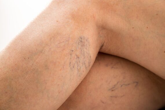 How to Treat Spider Veins Before Swimsuit Season