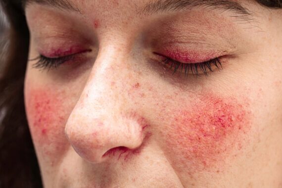 How to Protect My Skin in the Summer with Rosacea