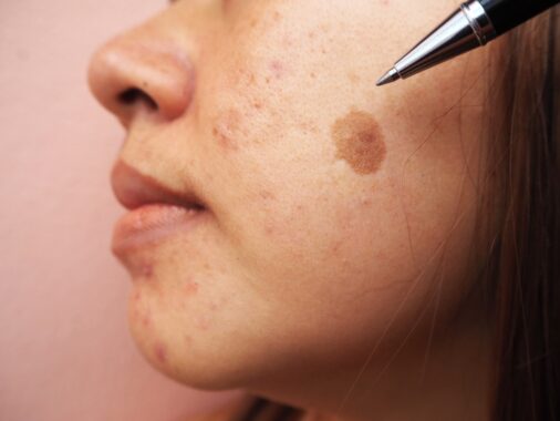 3 Treatment Options for Melasma and Brown Spots