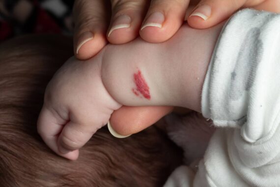 How to Get Rid of Pediatric Vascular Birthmarks