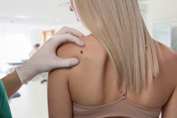 Mole Evaluations: When to See a Dermatologist
