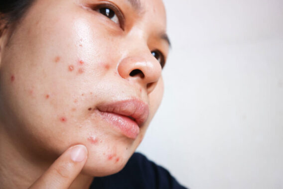 How Treating Acne Can Improve Your Mental Health