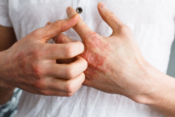 Dermatitis and Eczema: Know the Signs and Symptoms of This Common Skin Condition