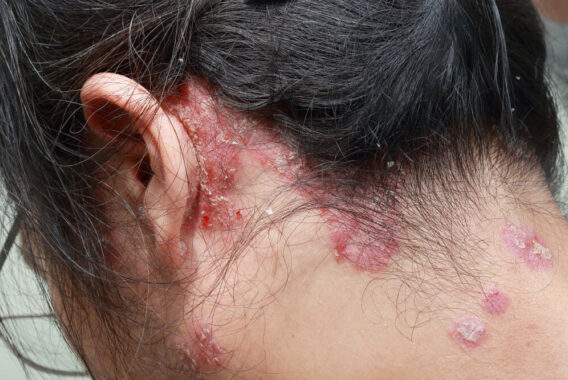How to Detect Psoriasis on the Scalp