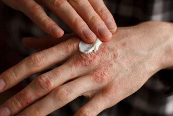 Diagnosed with Eczema? Try These Cold Weather Skin Care Tips