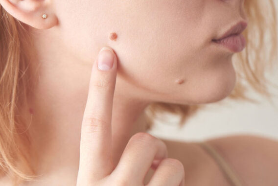 Getting Moles Removed: 6 Symptoms Dermatologists Look For