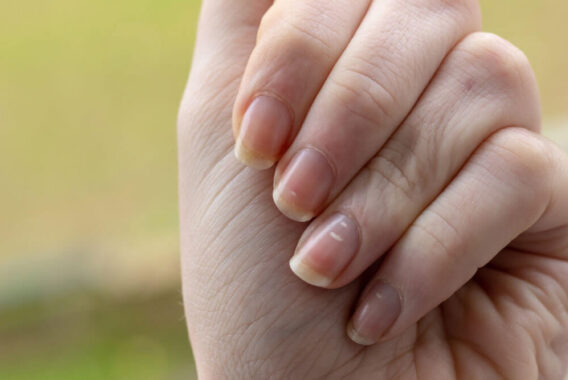How Your Dermatologists Treats 4 of the Most Common Nail Abnormalities