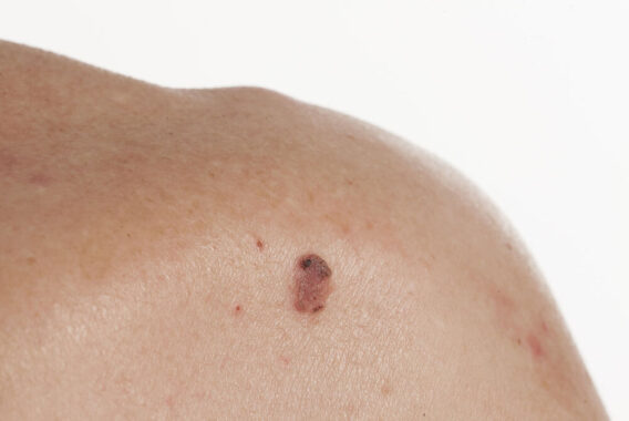 Skin Cancer Awareness Month: What 3 Things Should You Be Checking for When You’re Looking for Skin Cancer?