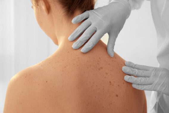 Skin Cancer Awareness: Is it Time for Another Skin Cancer Screening?