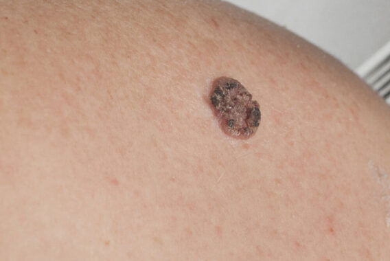 Diagnosing Skin Cancer: Spot the Warning Signs of Squamous Cell Carcinoma (SCC)?