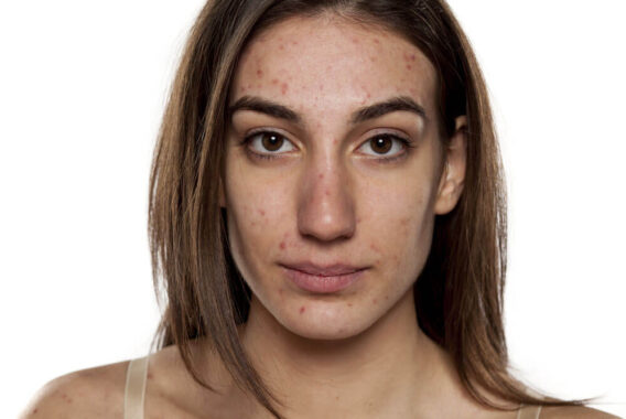 What Could Be Causing Your Adult Acne?