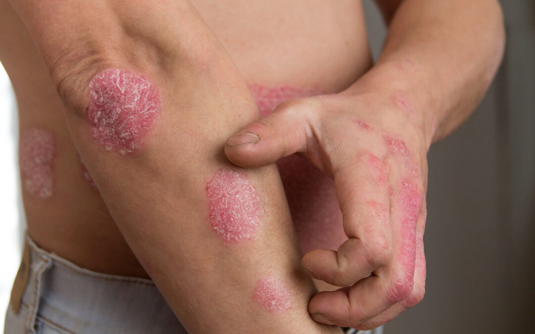 August is Psoriasis Awareness Month!