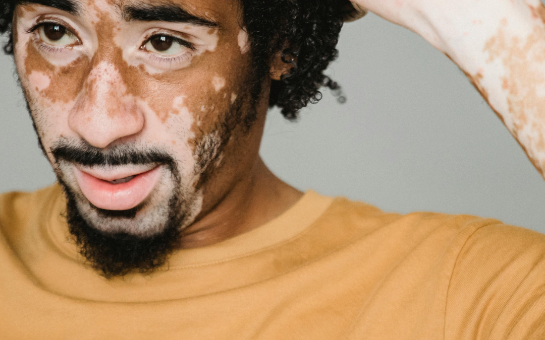 March is National Autoimmune Disease Awareness Month: How Dermatologists Help Manage Autoimmune Skin Conditions